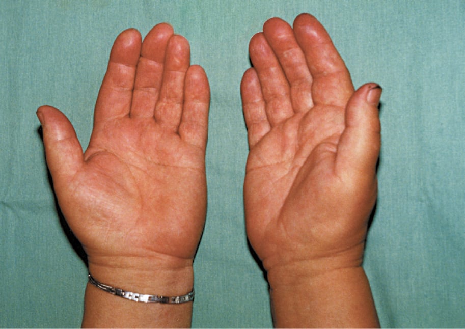 Figure 031_9418.  Erythromelalgia: distal bluish-red discoloration of the hands.  Figure courtesy of Dr Leszek Masłowski.  