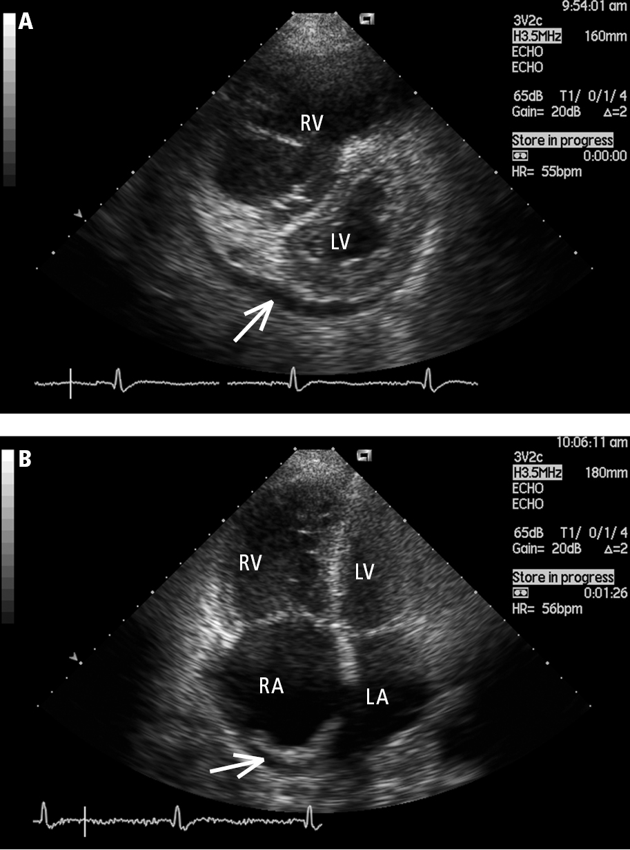 Figure 031_9568.  Transthoracic echocardiography (TTE), parasternal short-axis view (  A  ) and apical 4-chamber view (  B  ): a markedly enlarged right ventricle (RV) in a patient with idiopathic pulmonary hypertension. Left heart compression, right atrial (RA) dilation, and pericardial effusion (arrow) are markers of poor prognosis. LA, left atrium; LV, left ventricle.  Figure courtesy of Dr Adam Torbicki.  