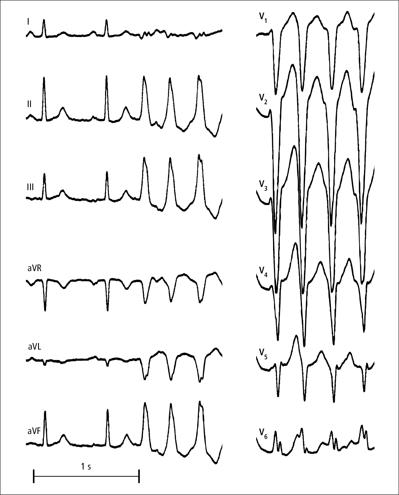 Figure 031_9760.  Episode of monomorphic right ventricular outflow tract tachycardia. 