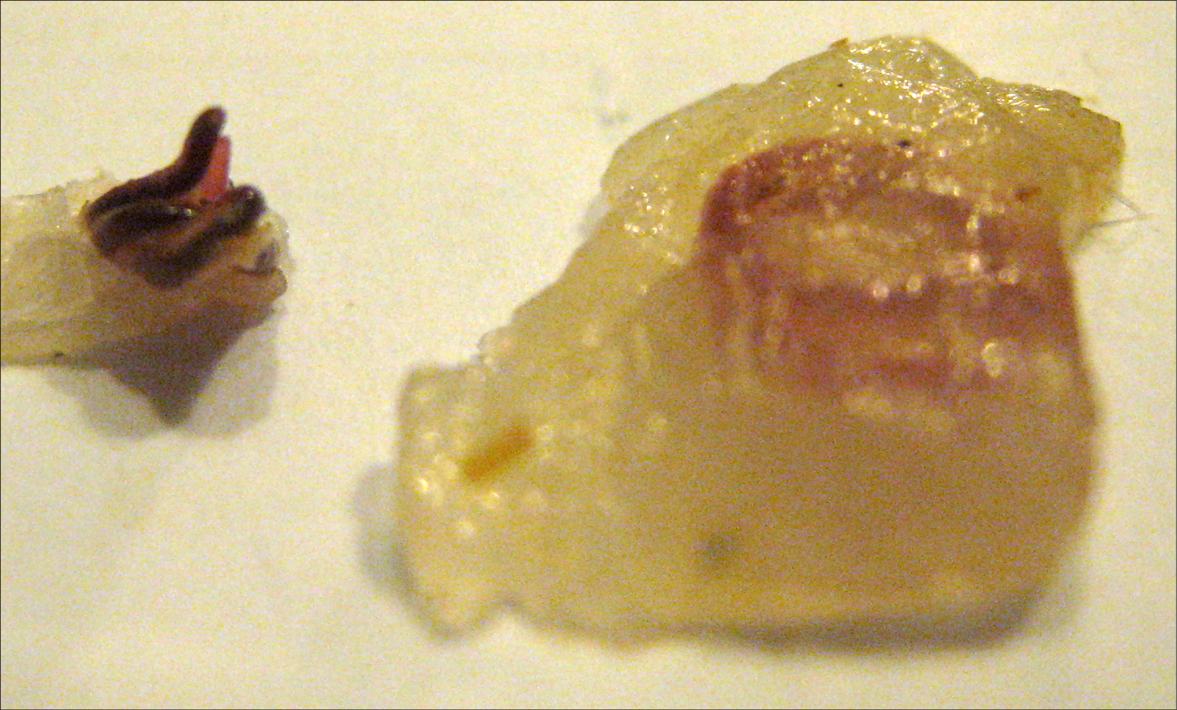    Fig. 19.4-3.  Larvas de  Pseudoterranova decipiens  (proporcionado por la Dra. Beata Szostakowska)  