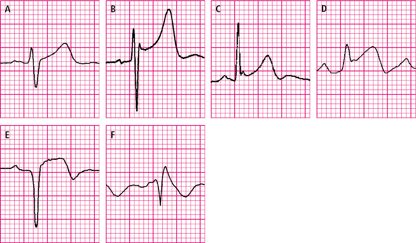    Fig. 27.1-5.  Elevación de los segmentos ST.  A:  elevación fisiológica oblicua hacia arriba.  B:  elevación del punto J con elevación cóncava del segmento ST en el síndrome de repolarización precoz.  C:  síndrome de repolarización precoz con una torsión de la fase final de la onda R.  D:  elevación del segmento ST registrado durante un episodio de angina de Prinzmetal.  E:  elevación del segmento ST en la fase aguda del infarto de miocardio (onda de Pardee).  F : elevación de los segmentos ST oblicuamente descendente en el síndrome de Brugada 