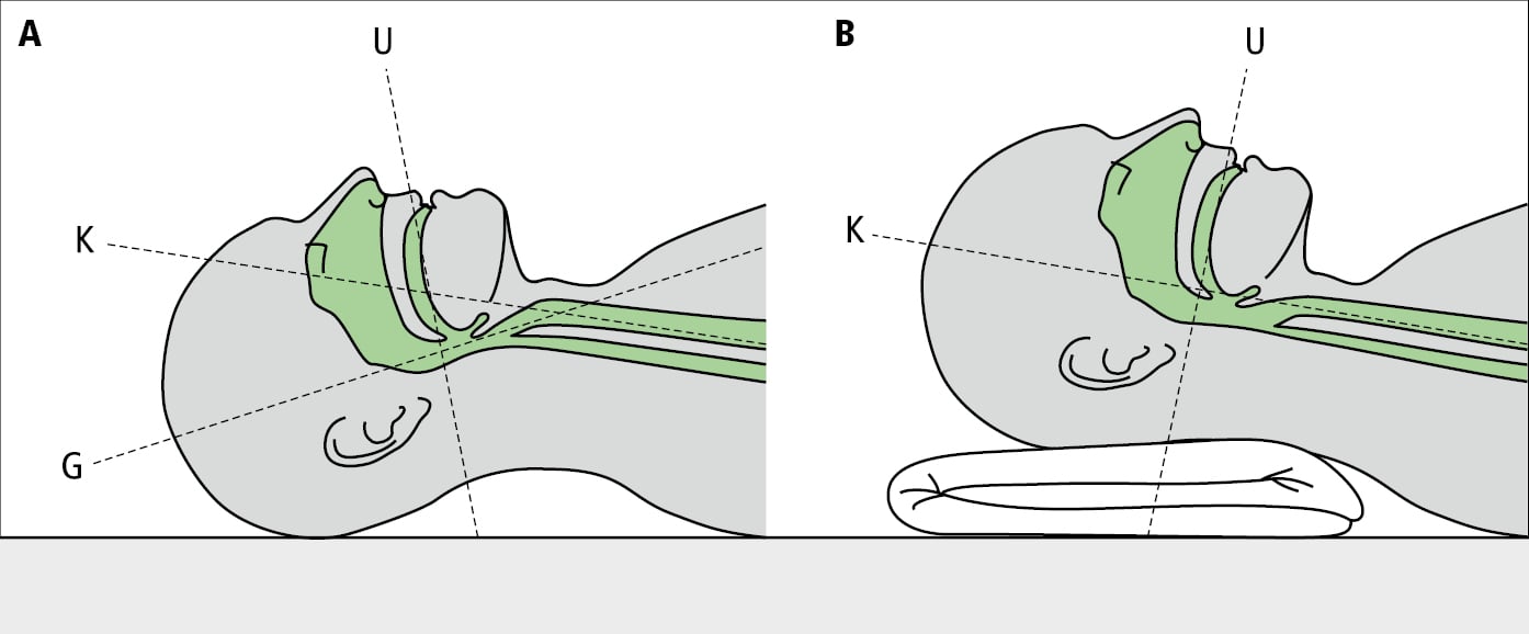    Fig. 26.19-1.   A:  representación esquemática del eje largo de la cavidad oral (O), faringe (F) y laringe (L).  B:  posición correcta de la cabeza del paciente antes de realizar la intubación: la elevación y una leve flexión de la cabeza permiten que los ejes de la laringe y de la faringe coincidan →cap. 24.19 