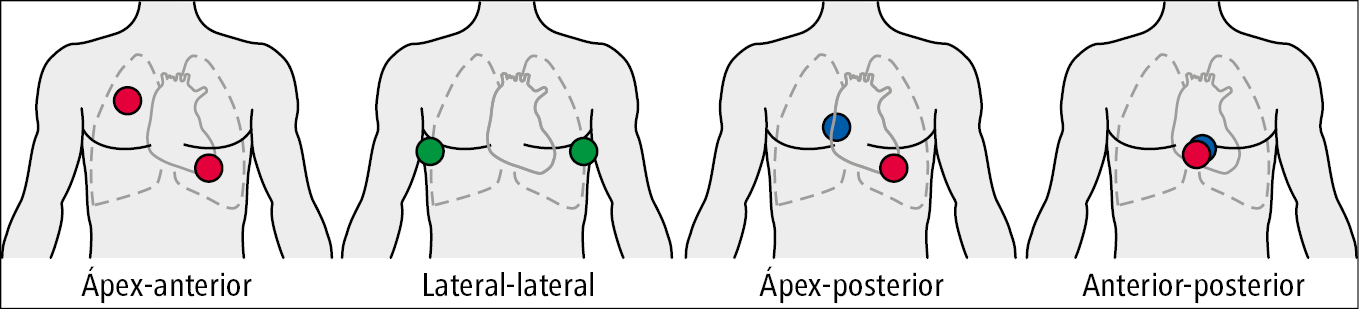    Fig. 2.1-4.  Localización recomendada de los electrodos para desfibrilación. Colocación en la parte anterior del tórax (rojo), lateral (verde) y posterior (azul) 