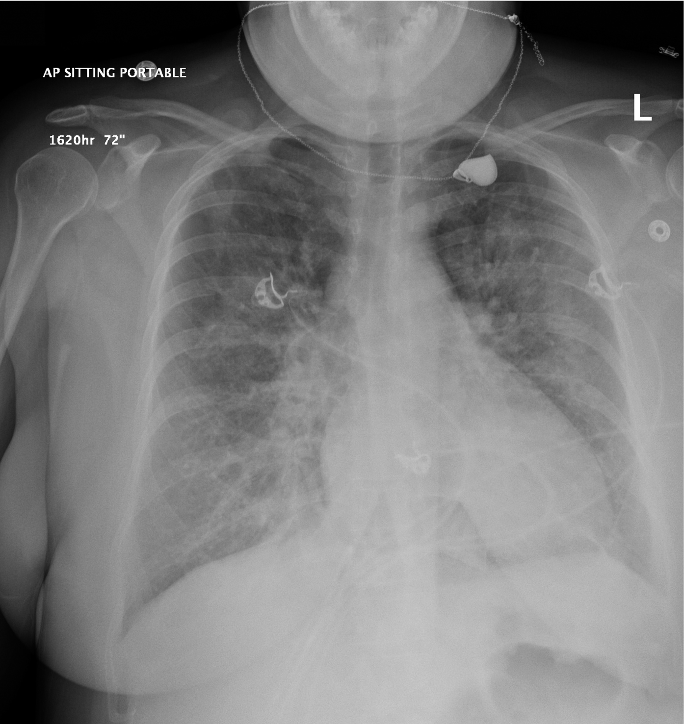  
Fig. 30.1-1.  Radiografía de tórax anteroposterior (AP). Paciente mujer de 35 años (caso n.º 1) con dolor torácico. Opacidades difusas y moteadas en ambos pulmones 