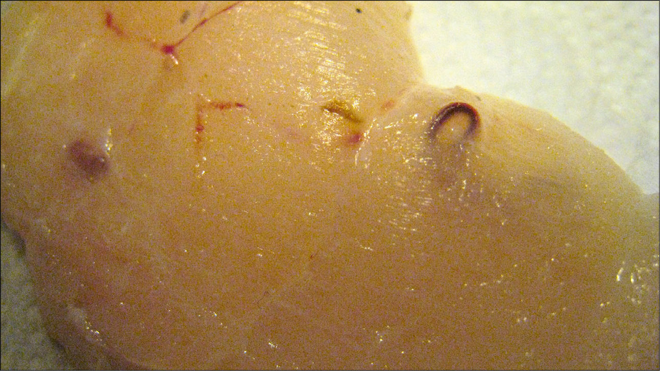    Fig. 19.4-2.  Larvas de  Pseudoterranova decipiens  en los músculos de un bacalao proveniente del Báltico (proporcionado por la Dra. Beata Szostakowska) 