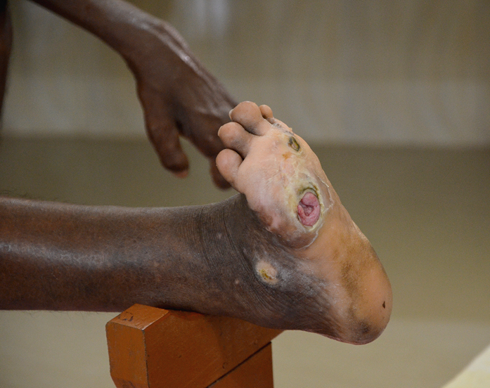    Fig. 19.2-1.  Lesiones de lepra en el pie (proporcionado por Waldemar Kus SVD) 