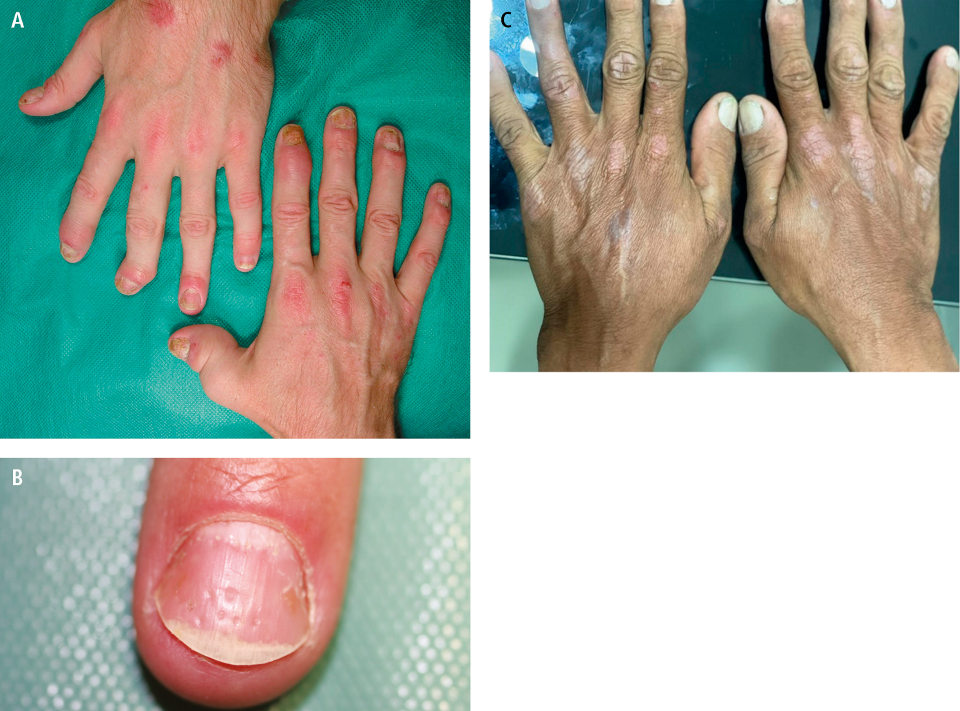    Fig. 1.8-2.  Artritis psoriásica.  A  — psoriasis de la superficie dorsal de ambas manos, 1. er  dedo de la mano derecha 