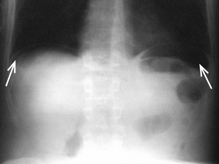    Fig. 4.29-3.  Radiografía simple de abdomen en bipedestación incluyendo cúpulas diafragmáticas: perforación de úlcera gástrica con aire libre visible (flechas) bajo las cúpulas diafragmáticas 