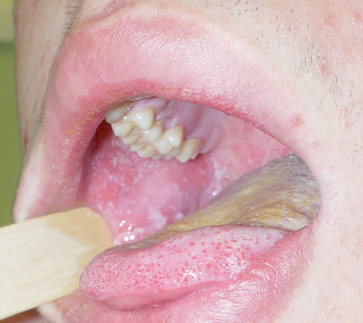    Fig. 19.1-1.  Sarampión: manchas de Koplik en la mucosa oral de la mejilla 