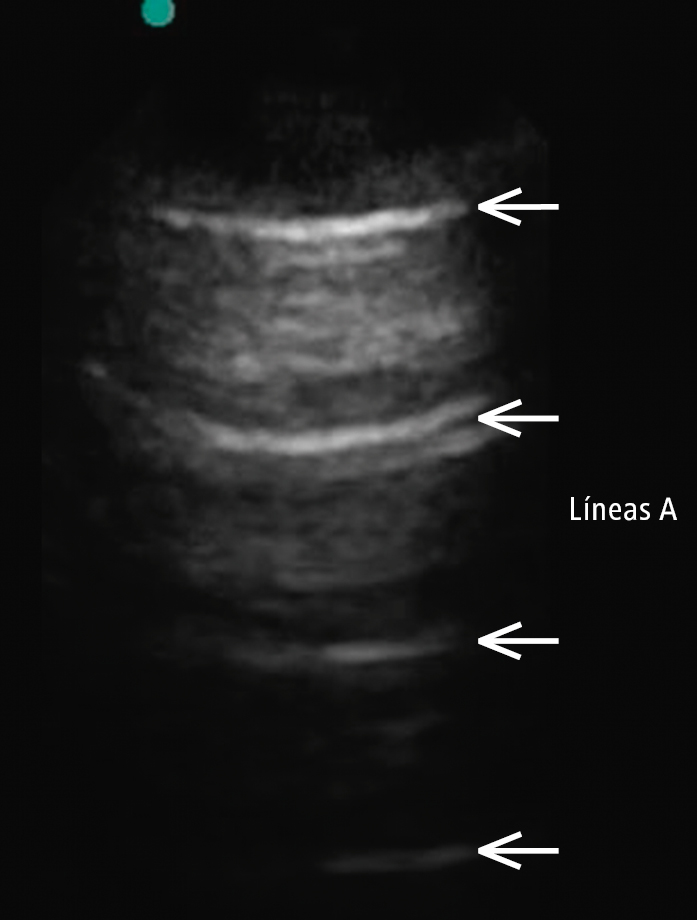    Fig. 30.2-1.  Patrón de línea A que sugiere una aireación normal del pulmón y se corresponde con una radiografía torácica normal. La línea A es un artefacto de reverberación repetitiva de la pleura 