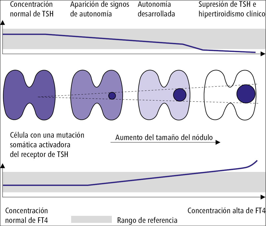    Fig. 9.2-1.  Desarrollo del nódulo tiroideo autónomo 
