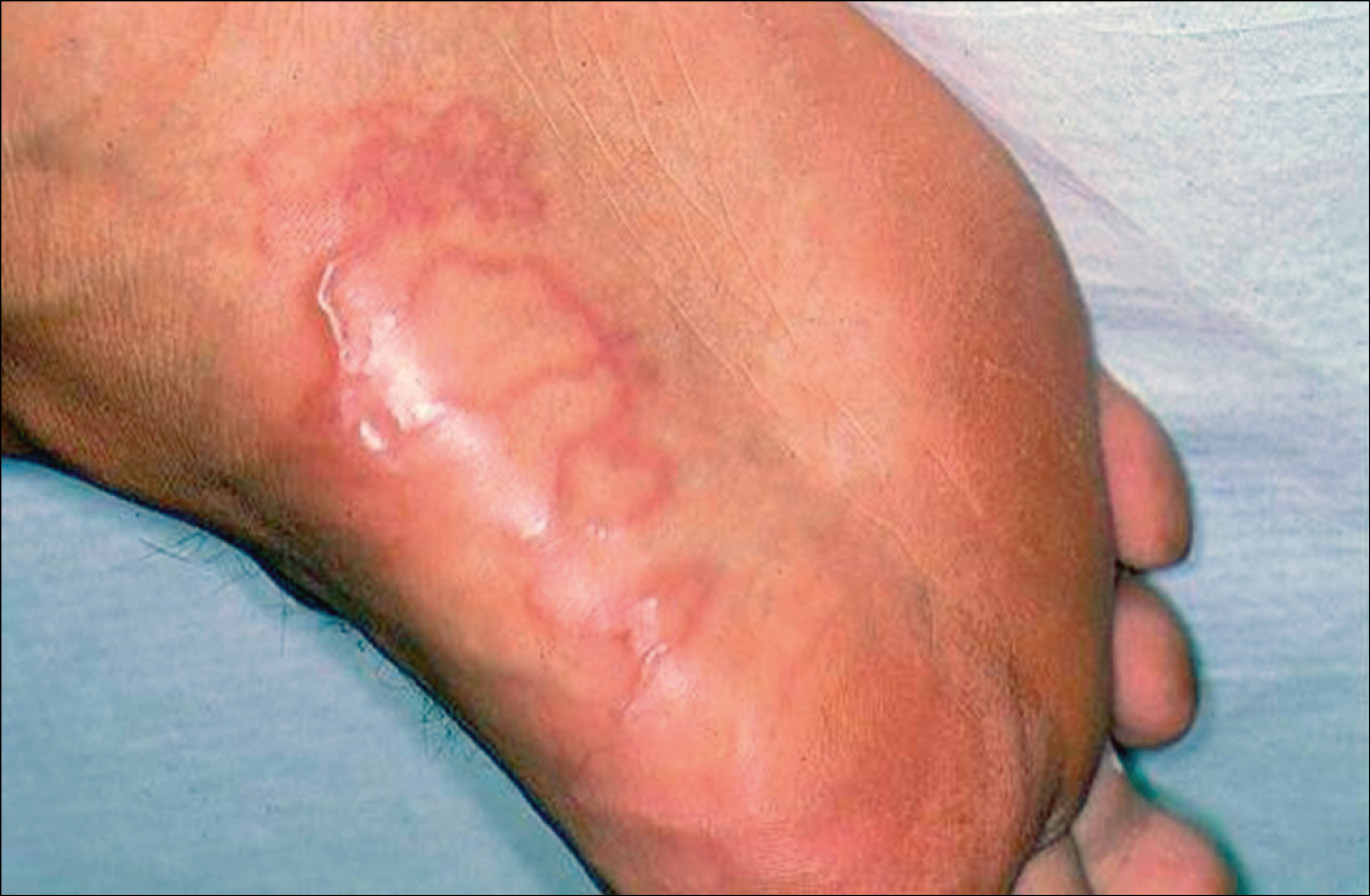    Fig. 19.4-1.  Lesiones cutáneas serpentiginosas en el lado plantar del pie derecho en una mujer de 47 años después de regresar de Tailandia, causadas por  Ancylostoma brasiliense  