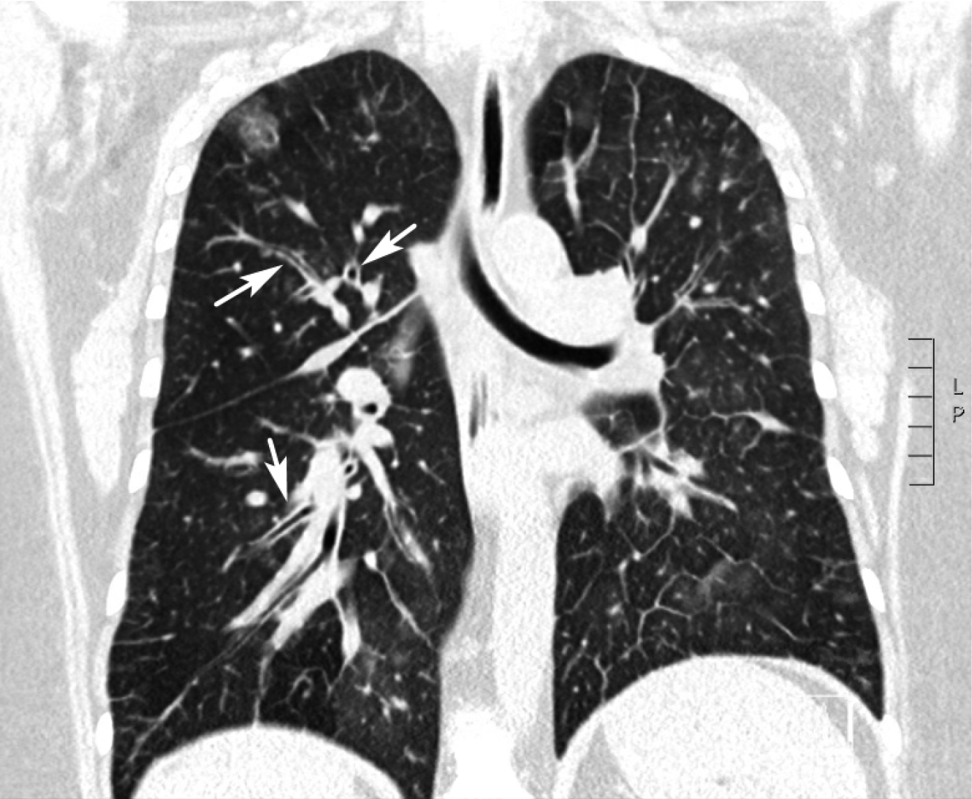  
Fig. 30.1-7.  Tomografía computarizada (TC) coronal de una paciente de 35 años (caso n.º 1) que evidencia bronquios engrosados (flechas) 