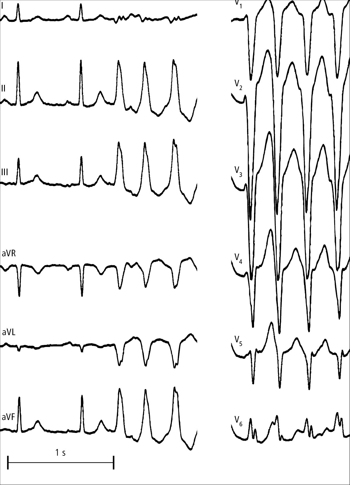    Fig. 2.6-1.  Episodio de taquicardia ventricular monomorfa del tracto de salida del ventrículo derecho 