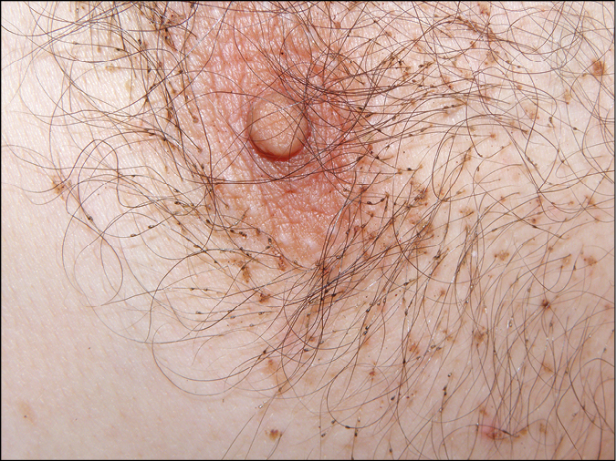    Fig. 19.4-1.  Pediculosis en el vello pectoral en un paciente con inmunosupresión: liendres de los piojos púbicos 