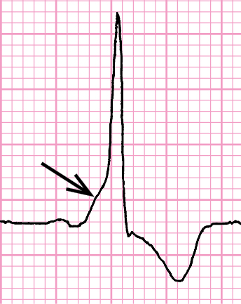    Fig. 2.6-1.  Síndrome de preexcitación: intervalo PQ corto, onda delta en la rama ascendente de la onda R (flecha), dirección opuesta del segmento ST y de la onda T a la del complejo QRS ancho 
