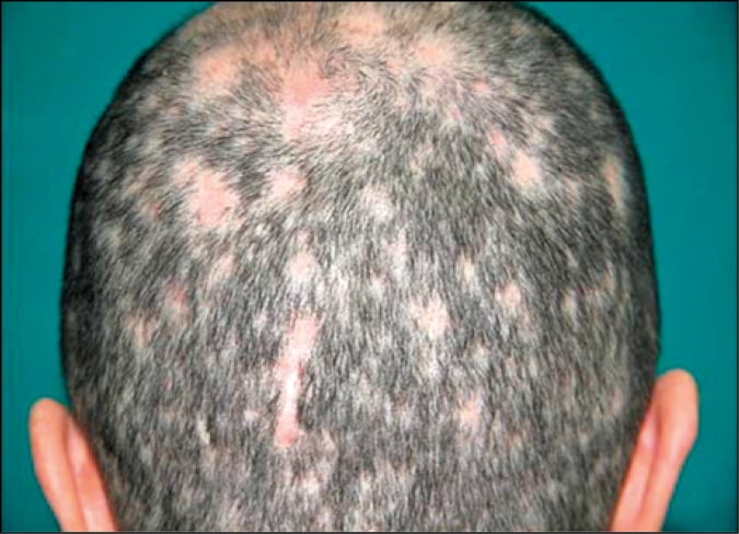    Fig. 19.2-5.  Alopecia focal en el curso de la sífilis recurrente secundaria 