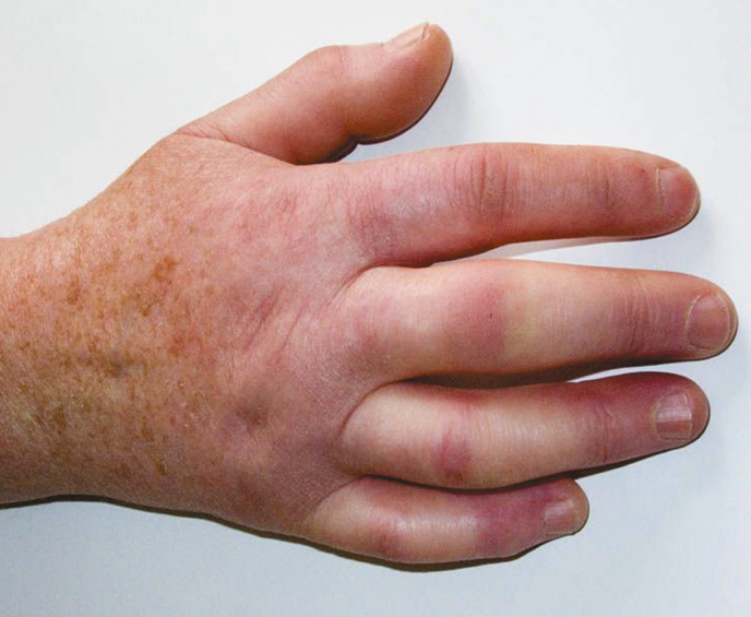    Fig. 1.8-4.  Esclerosis sistémica: piel de los dedos brillante, endurecida, dificulta la extensión y flexión completas de los dedos (como en guante apretado) 
