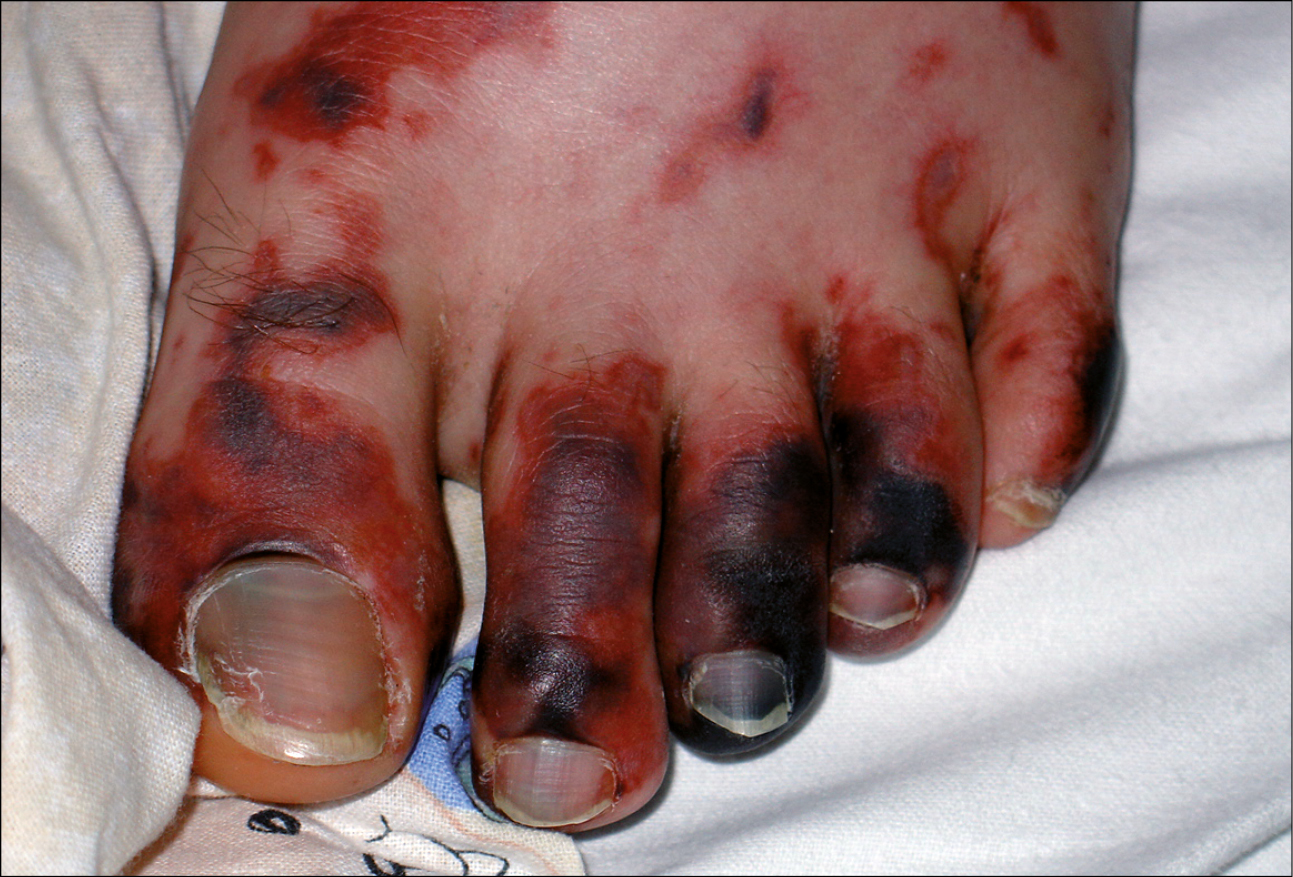    Fig. 19.9-2.  Equimosis y necrosis de los dedos de los pies en el curso de sepsis meningocócica 