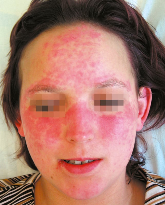    Fig. 17.3-1.  Lupus eritematoso sistémico, típico eritema malar 