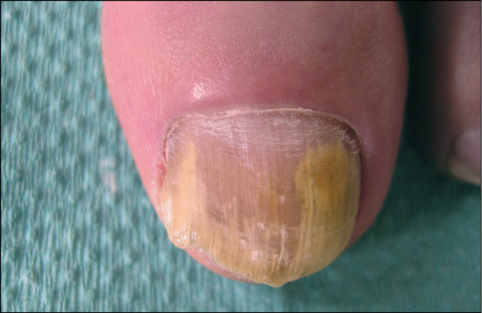    Fig. 19.3-1.  Onicomicosis subungueal distal y lateral. La infección desde el borde libre de la una avanza hacia el pliegue ungueal. Cambio de coloración visible (lechosa) de la parte enferma de la lámina ungueal 