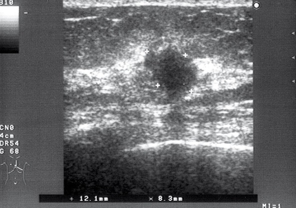 cancer mamar ecografie ovarian cancer during pregnancy