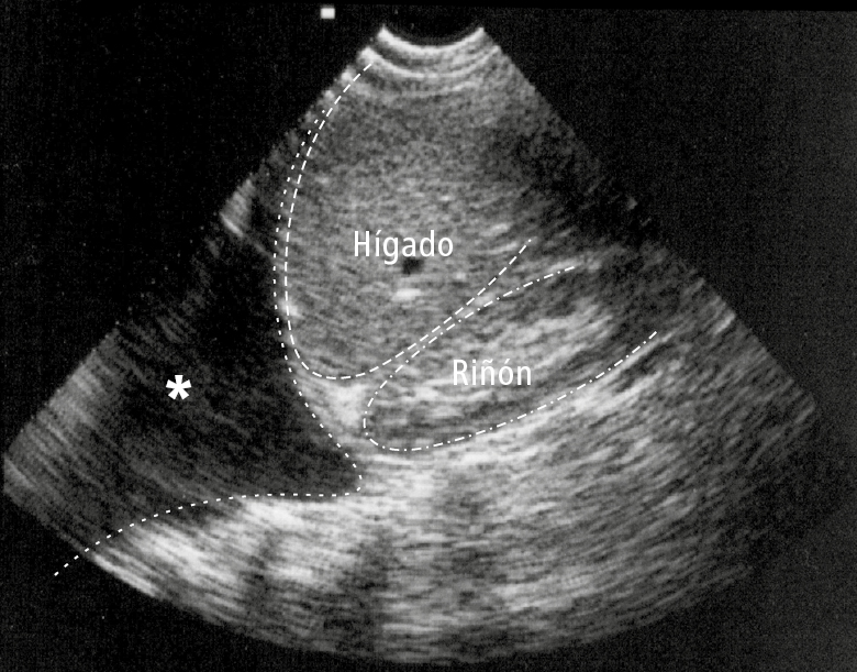    Fig. 26.8-2.  Imagen ecográfica de la región subcostal derecha que muestra derrame pleural (asterisco) 
