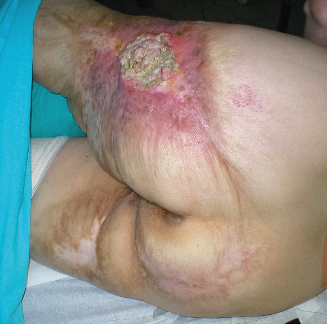    Fig. 24.8-5.  Úlcera de Marjolin: carcinoma escamocelular sobre una cicatriz de quemadura 