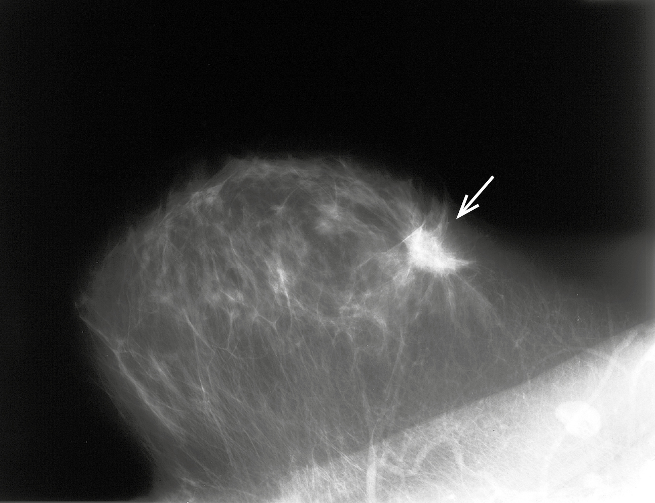    Fig. 24.5-2.  Imagen mamográfica de cáncer de mama (proporcionado por la Dra. Sonia Dyczek) 