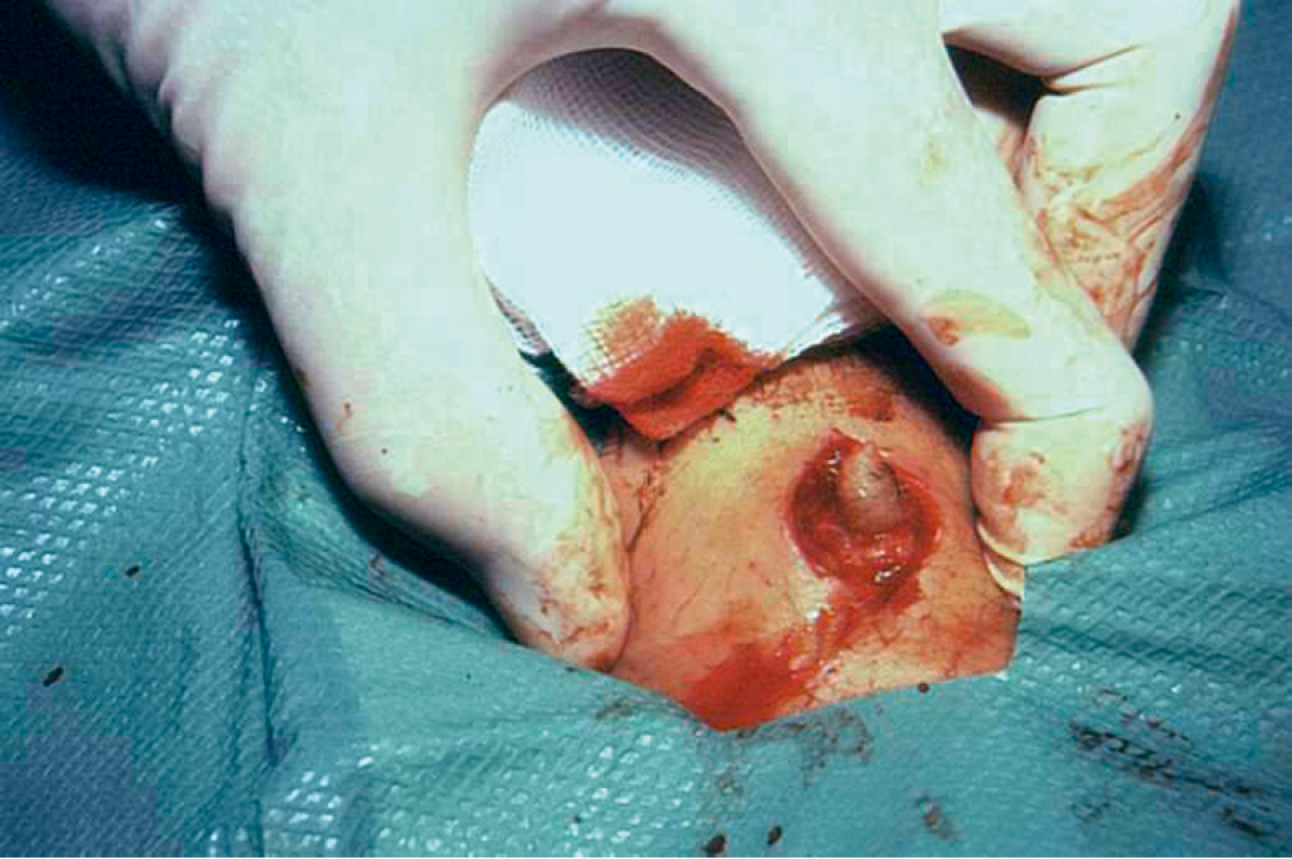    Fig. 19.4-1.  Larva viva visible en el fondo de la herida durante la cirugía 