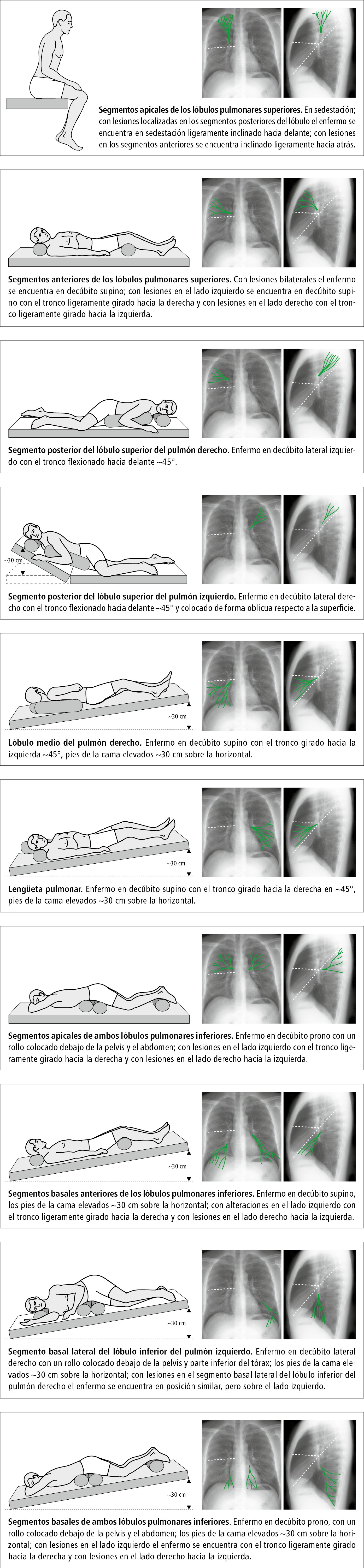    Fig. 26.20-1.  Posiciones para el drenaje postural estático 