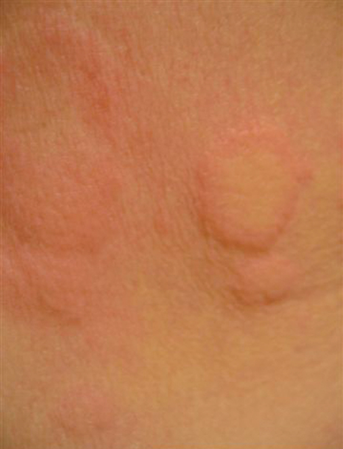    Fig. 18.4-1.  Urticaria (foto: dra. Monika Kapińska-Mrowiecka) 