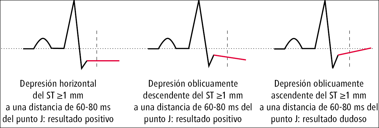    Fig. 27.1-1.  Métodos de medición del desplazamiento del segmento ST en el ECG de esfuerzo 