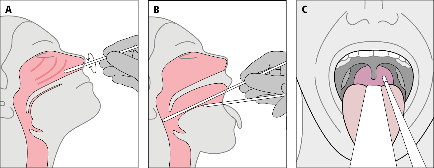    Fig. 26.31-1.  Toma de frotis de nariz (A) y garganta (B y C)  