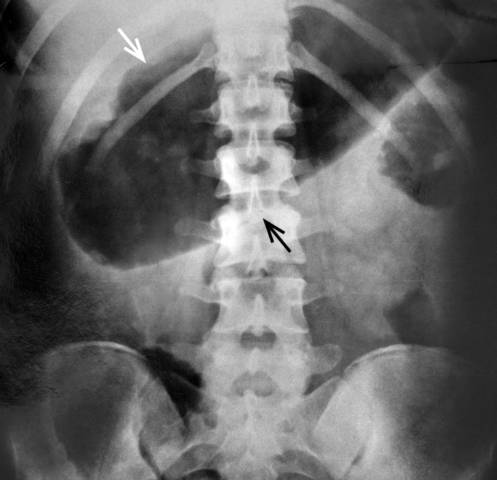    Fig. 4.19-1.  Megacolon tóxico (dilatación aguda del colon) en radiografía simple de abdomen; diámetro transverso a nivel de la línea media de 11 cm (flechas) 