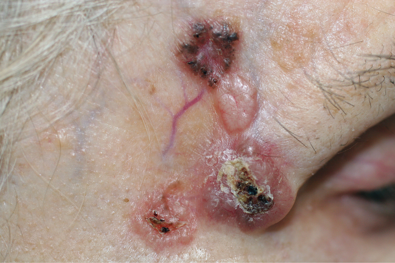    Fig. 24.8-1.  Tres focos del carcinoma basocelular en la piel de la región temporal: los bordes sobreelevados y la ulceración central característicos (proporcionado por la Profa. Anna Wojas-Pelc) 