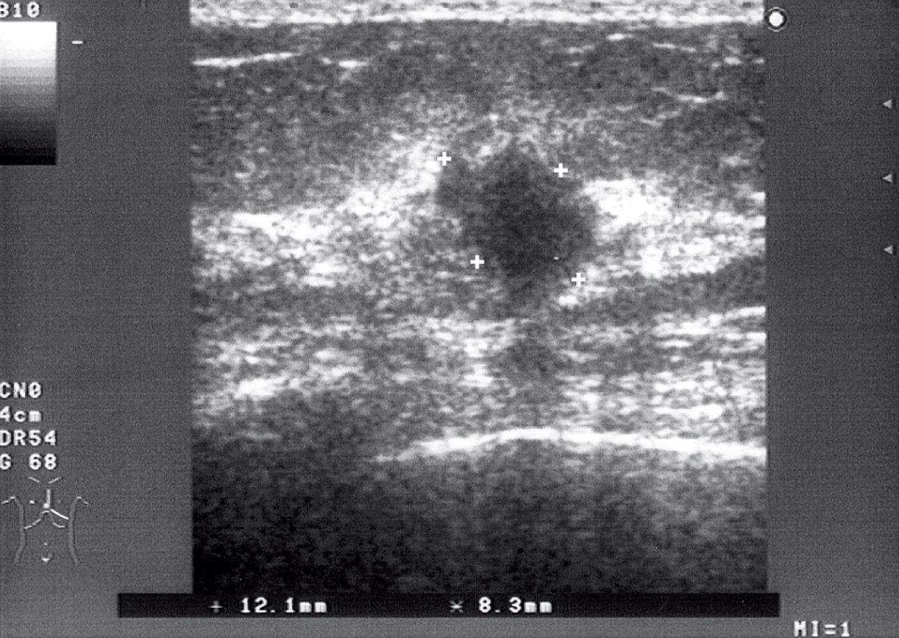    Fig. 24.5-3.  La ecografía de la mama izquierda evidencia un área hipodenso e irregular (cáncer ductal) (proporcionado por la Dra. Sonia Dyczek) 