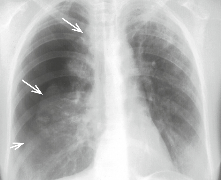    Fig. 3.19-1.  Neumotórax de gran tamaño (≥2 cm; las flechas indican el borde del pulmón) 