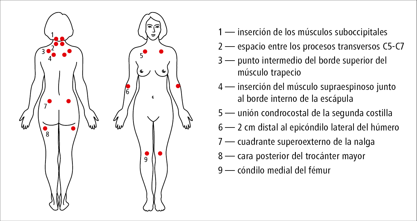    Fig. 17.20-1.  Puntos dolorosos en la fibromialgia 