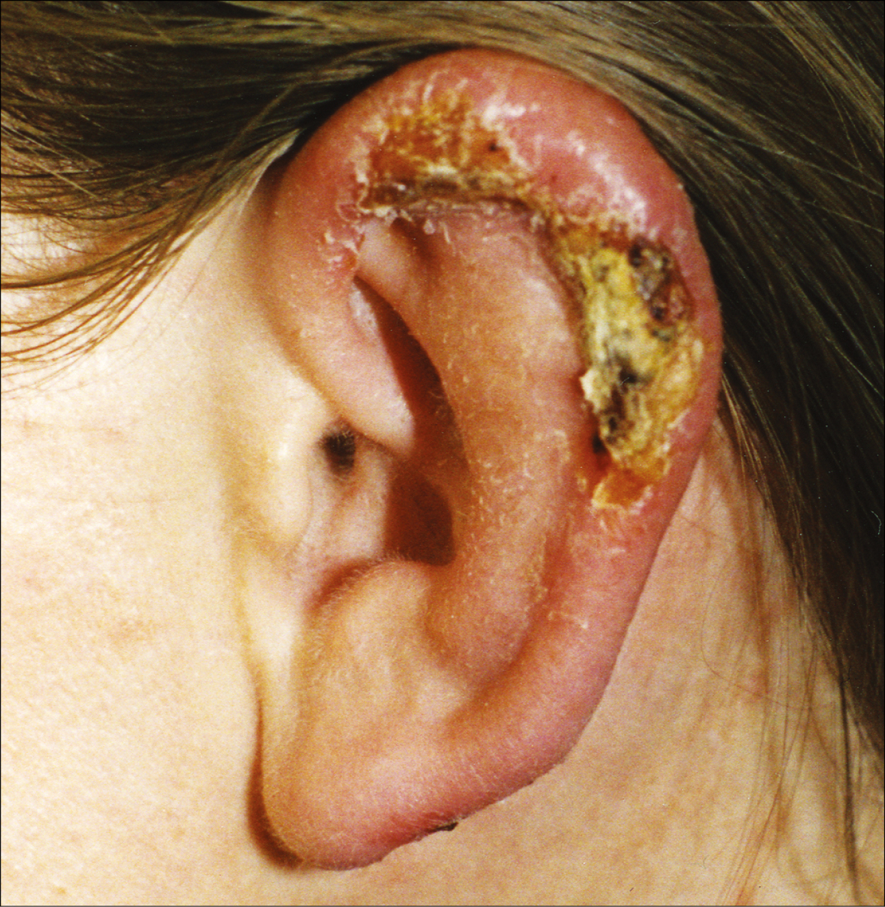    Fig. 19.4-1.  Leishmaniasis cutánea: ulceraciones cubiertas por costra en la oreja 