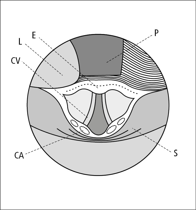    Fig. 26.19-3.  Vista de la entrada laríngea durante la laringoscopia directa (realizada con laringoscopio de pala curva): lengua (L), epiglotis (E), cuerda vocal (CV), cartílago aritenoides (CA), seno piriforme (S), pala del laringoscopio (P) 