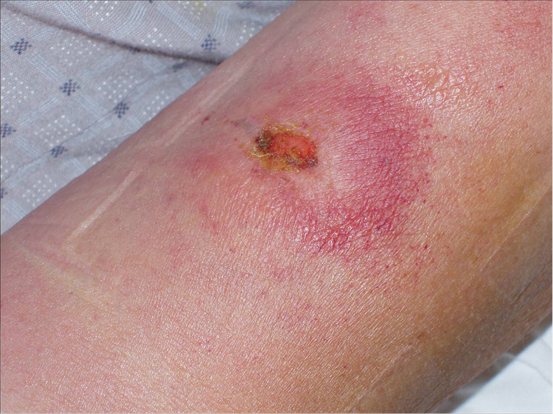    Fig. 19.4-3.  Chancro característico en la piel del brazo izquierdo en un paciente infectado por T. brucei rhodesiense durante su estancia en Uganda 