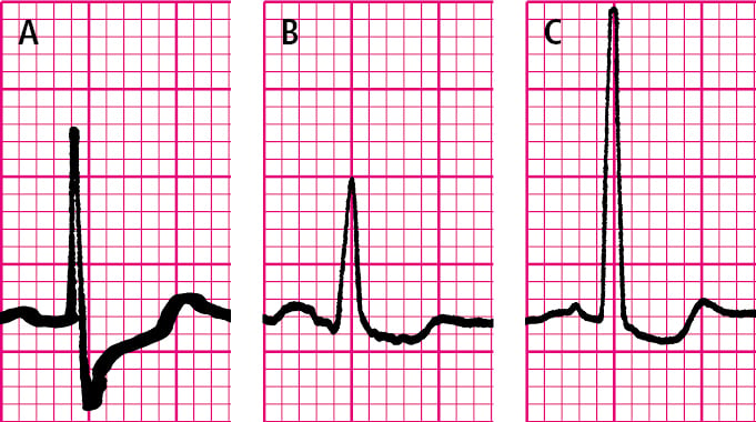    Fig. 27.1-6.  Depresión de los segmentos ST.  A:  oblicua hacia arriba.  B:  horizontal.  C:  oblicua hacia abajo 