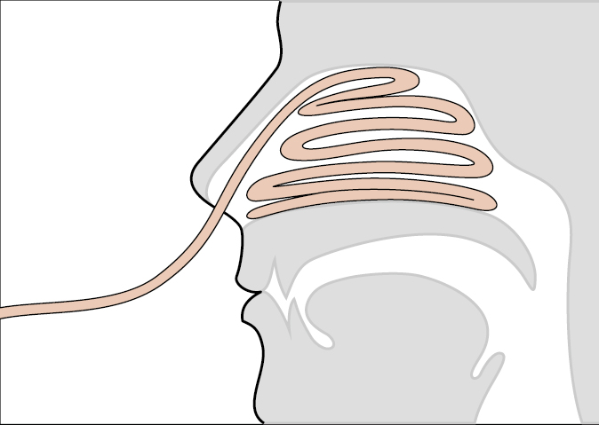    Fig. 25.23-2.  Taponamiento nasal anterior 