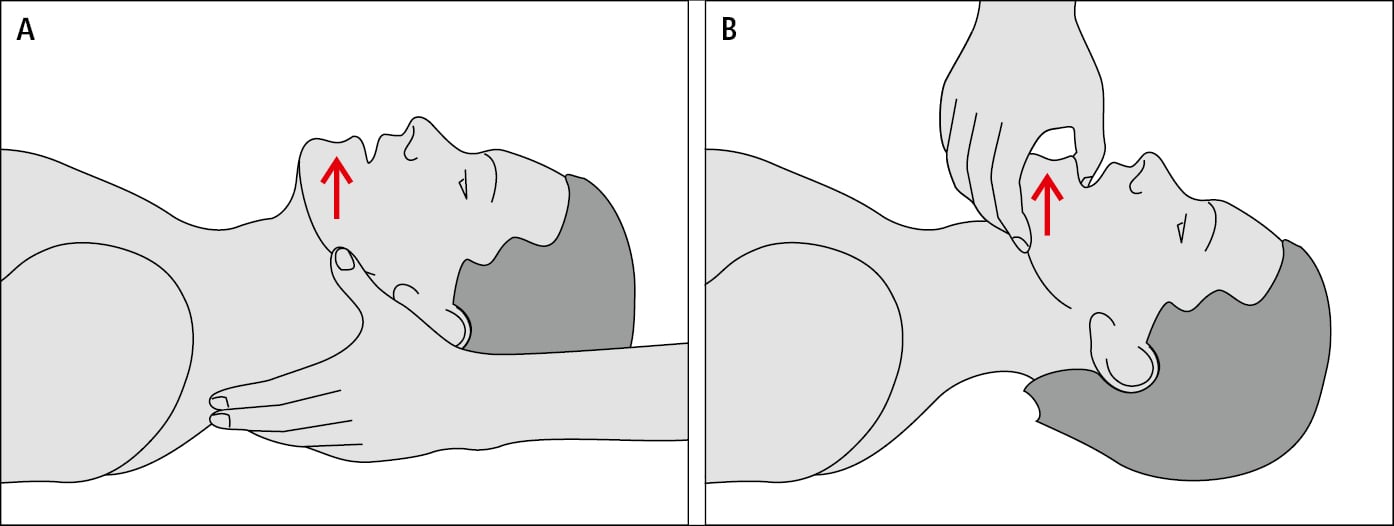    Fig. 25.8-2.  Permeabilización de las vías respiratorias a través de  A  — desplazamiento de la mandíbula hacia delante,  B  — tracción de la mandíbula hacia delante por medio de los dientes (elevación de la mandíbula) 
