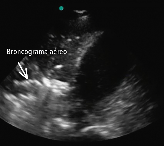    Fig. 30.2-5.  Consolidación translobar en el lóbulo inferior derecho con hepatización pulmonar, además de broncograma aéreo dinámico (véase el vídeo 4, que demuestra el broncograma aéreo dinámico en el área de la flecha) 