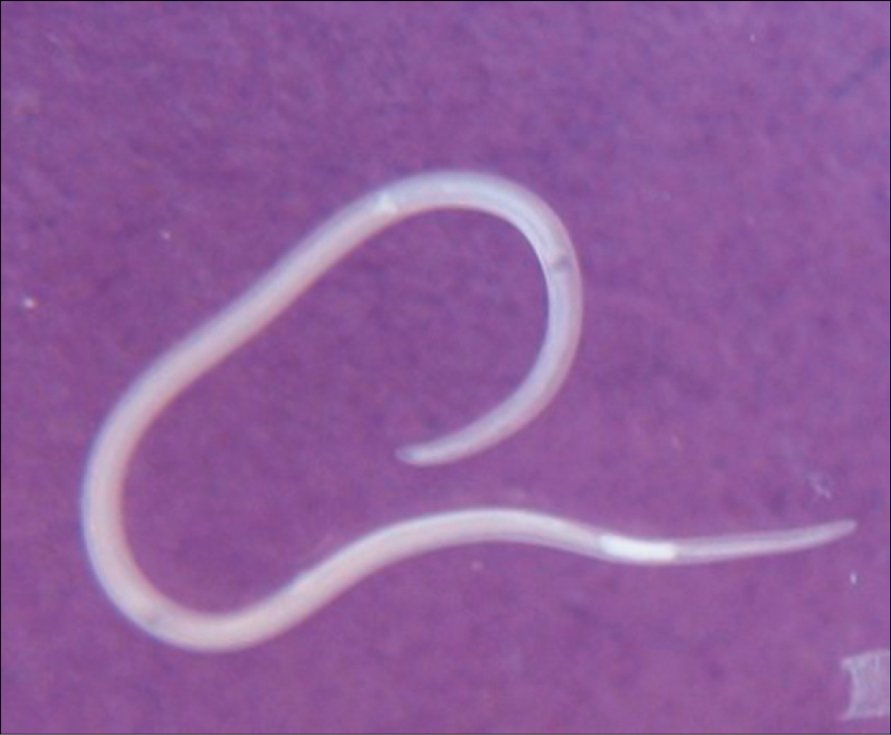    Fig. 19.4-1.  Larva de  Anisakis simplex  con estómago visible (proporcionado por la Dra. Beata Szostakowska) 