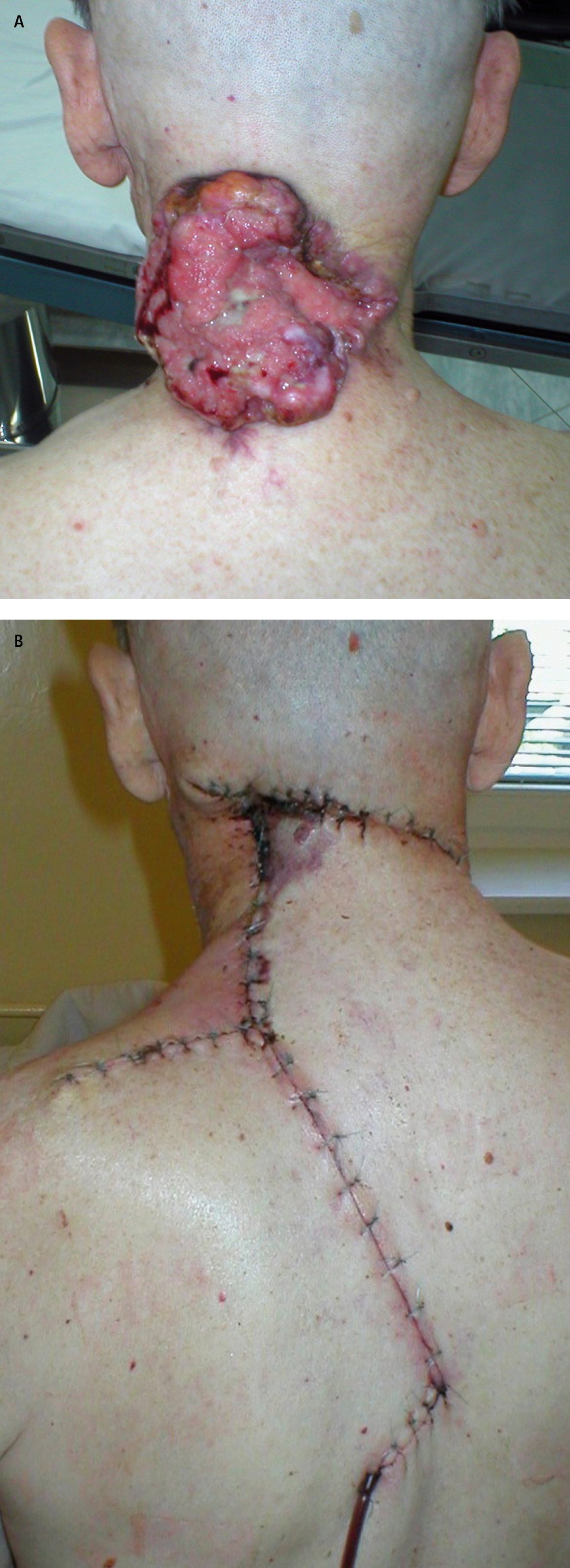    Fig. 24.8-3.  Carcinoma basocelular avanzado.  A:  estado antes de la cirugía,  B:  estado tras la extirpación completa y cirugía plástica local 
