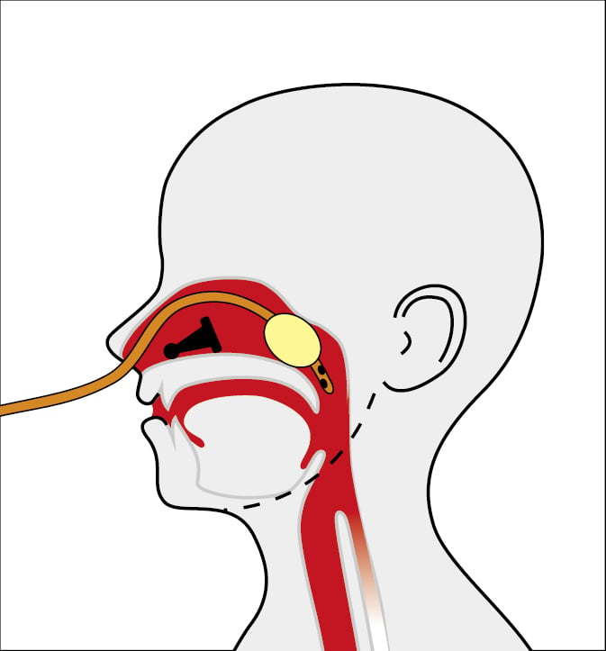    Fig. 25.24-1.  Extracción de un cuerpo extraño de la cavidad nasal con ayuda de la sonda de Foley 