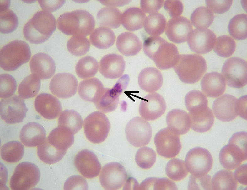    Fig. 19.4-2.  Frotis de sangre capilar de un enfermo con malaria, realizado con tinción de Giemsa. Se observa un gametocito de  Plasmodium falciparum  (flecha) (proporcionado por la Dra. Danuta Cielecka) 